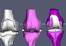 In kinematic alignment, 3D models of patients' knees, based on MRI scans, are used to create personalized cutting guides that surgeons use to prepare the bones around the artificial knee.   