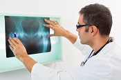 Tryptophan may protect against hip fractures