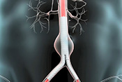 New treatment may reduce abdominal aortic aneurysms, preventing rupture