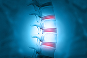 Injectable gel could help treat degenerative back pain