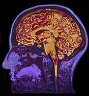 Brain volume abnormalities linked to impulsive suicide attempts