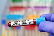 Bad cholesterol may be risk factor for Alzheimer’s
