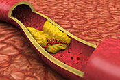 New cholesterol drug not cost-effective - Photo: ©iStock/jamesbenet