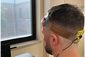 Supervised electrical stimulation may reduce posttraumatic headaches