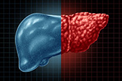 VA study identifies potential new treatment for fatty liver disease