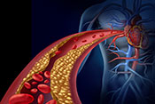 Detecting coronary heart disease using genetic data - Photo: ©iStock/wildpixel