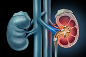 Process behind kidney stone formation
