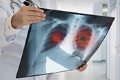 Assessment tool can help weigh risks of lung cancer surgery