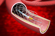 Elective percutaneous coronary interventions in VA largely appropriate