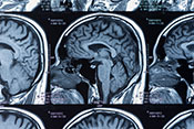 Long-term posttraumatic stress tied to changes in brain structure - Photo: ©iStock/Utah778
