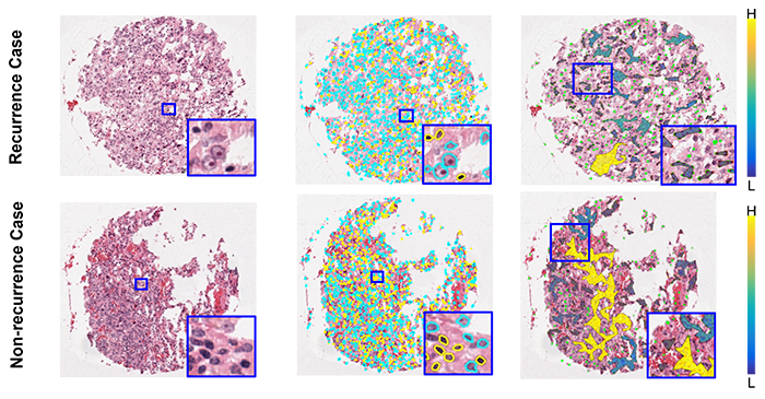 SpaTIL was developed to interrogate the spatial interaction of immune cells as a potential biomarker to predict recurrence prognosis (Breast cancer), response and overall survival (Lung cancer). 