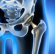 New prosthetic improves hip replacement 