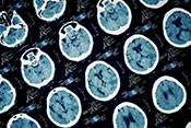 Even a mild head injury increases risk for Parkinson's disease, veterans study shows