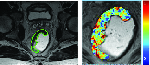  Diagnostic MRI scan of rectal cancer tumor (left) with AI visualization (right).