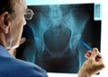 A physician examines a hip bone X-ray. Researchers say high levels of a protein called cystatin C may signal greater risk for hip fracture in older people.  
