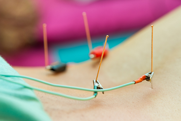https://www.research.va.gov/images/research-currents/mar17/Electroacupuncture.jpg