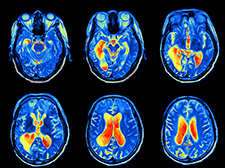 Dr. Michael Weiner's group at the San Francisco VA used MRI scans and other measures to investigate the link between traumatic brain injuries and Alzheimer's disease. (Photo ©iStock/alkesak)