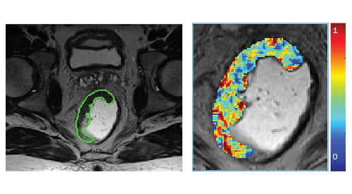 VA researchers using AI to decide best treatment for rectal cancer 