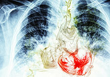 For low-risk patients, screening for lung cancer can be a choice